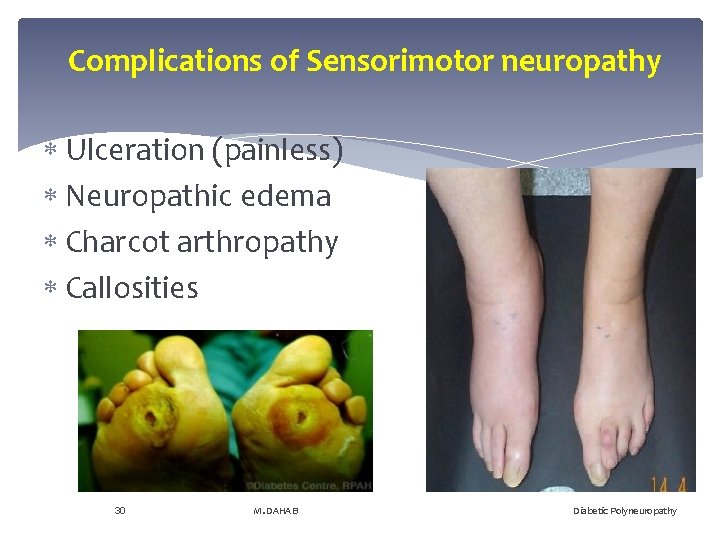 Complications of Sensorimotor neuropathy Ulceration (painless) Neuropathic edema Charcot arthropathy Callosities 30 M. DAHAB