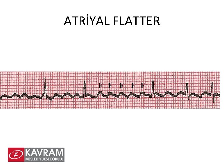 ATRİYAL FLATTER 