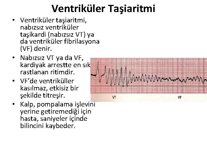 Ventriküler Taşiaritmi • Ventriküler taşiaritmi, nabızsız ventriküler taşikardi (nabızsız VT) ya da ventriküler fibrilasyona