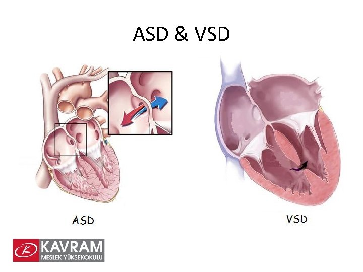 ASD & VSD 