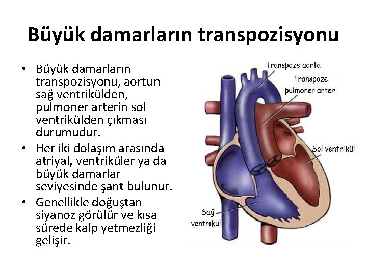 Büyük damarların transpozisyonu • Büyük damarların transpozisyonu, aortun sağ ventrikülden, pulmoner arterin sol ventrikülden