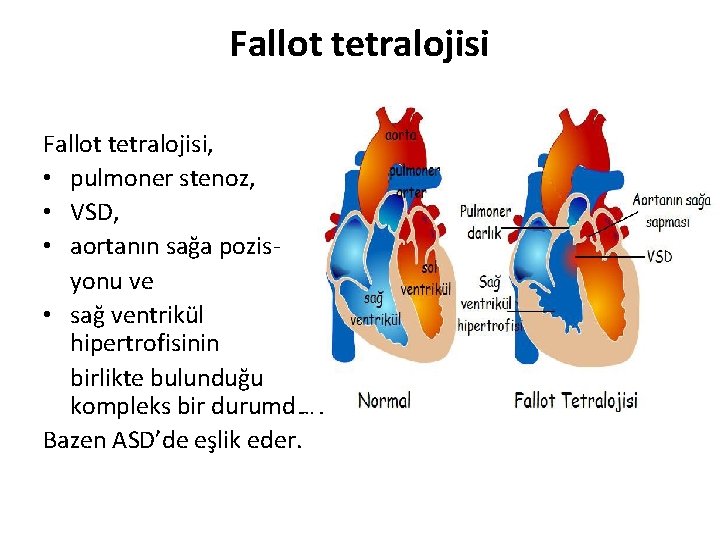 Fallot tetralojisi, • pulmoner stenoz, • VSD, • aortanın sağa pozisyonu ve • sağ