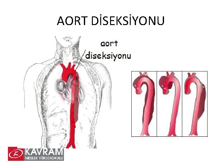 AORT DİSEKSİYONU 