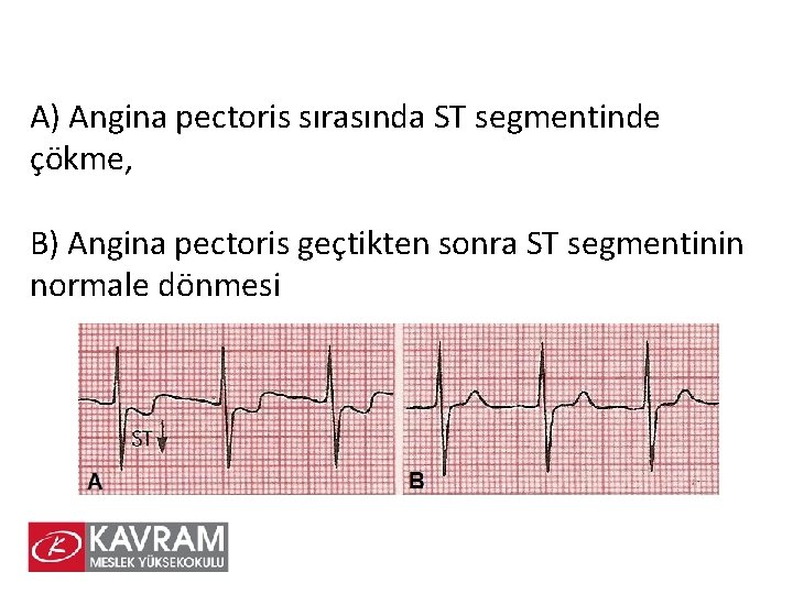 A) Angina pectoris sırasında ST segmentinde çökme, B) Angina pectoris geçtikten sonra ST segmentinin