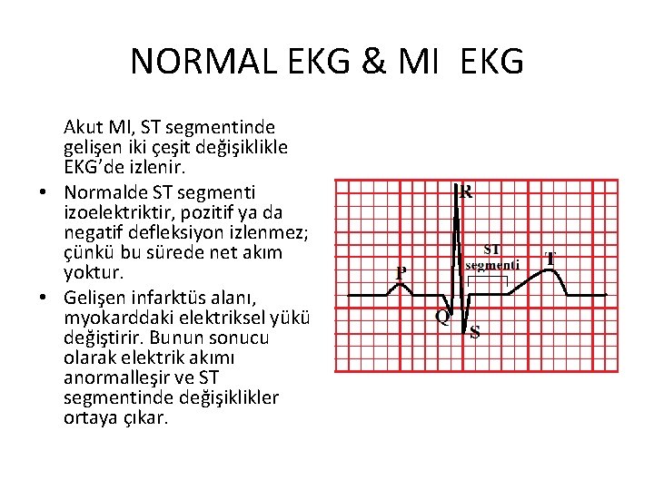 NORMAL EKG & MI EKG Akut MI, ST segmentinde gelişen iki çeşit değişiklikle EKG’de