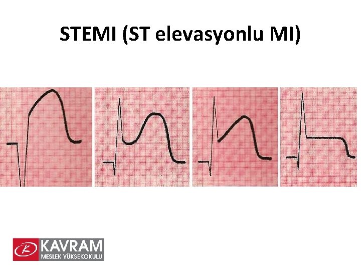 STEMI (ST elevasyonlu MI) 