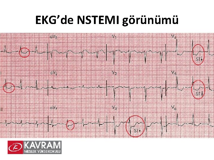 EKG’de NSTEMI görünümü 