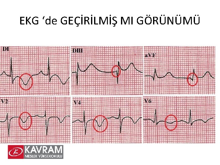 EKG ‘de GEÇİRİLMİŞ MI GÖRÜNÜMÜ 