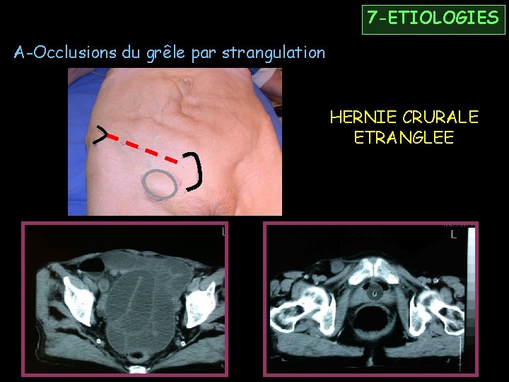 7 -ETIOLOGIES A-Occlusions du grêle par strangulation HERNIE CRURALE ETRANGLEE 
