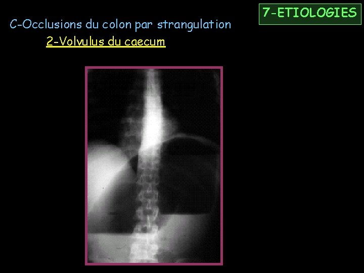 C-Occlusions du colon par strangulation 2 -Volvulus du caecum 7 -ETIOLOGIES 