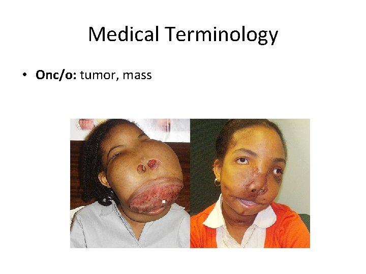 Medical Terminology • Onc/o: tumor, mass 