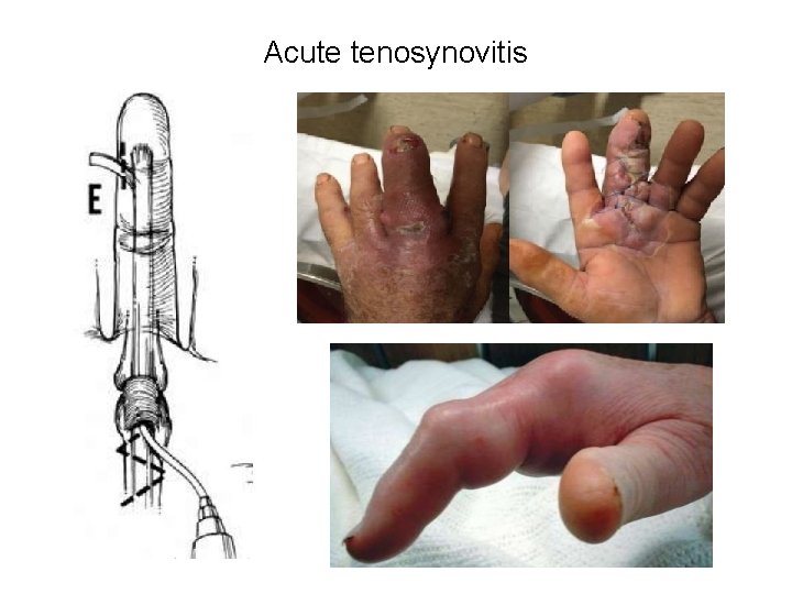 Acute tenosynovitis 