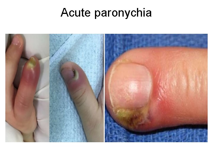 Acute paronychia 
