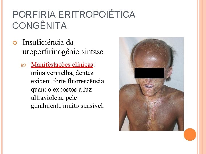 PORFIRIA ERITROPOIÉTICA CONGÊNITA Insuficiência da uroporfirinogênio sintase. Manifestações clínicas: urina vermelha, dentes exibem forte