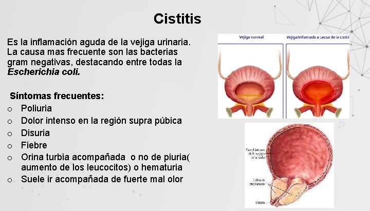Cistitis Es la inflamación aguda de la vejiga urinaria. La causa mas frecuente son