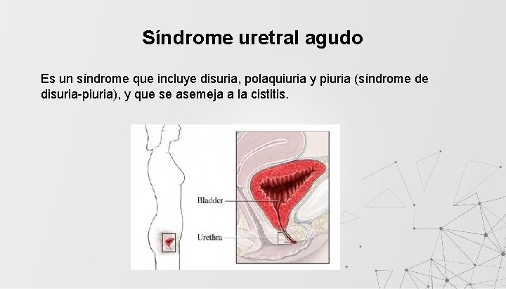 Síndrome uretral agudo Es un síndrome que incluye disuria, polaquiuria y piuria (síndrome de