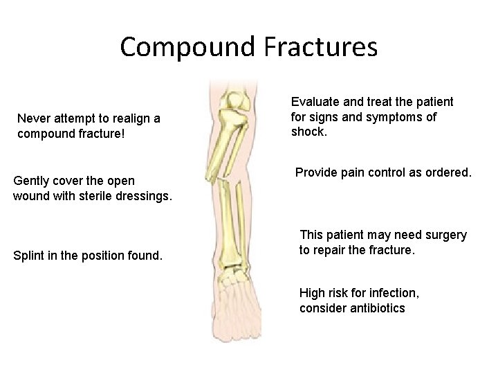 Compound Fractures Never attempt to realign a compound fracture! Gently cover the open wound