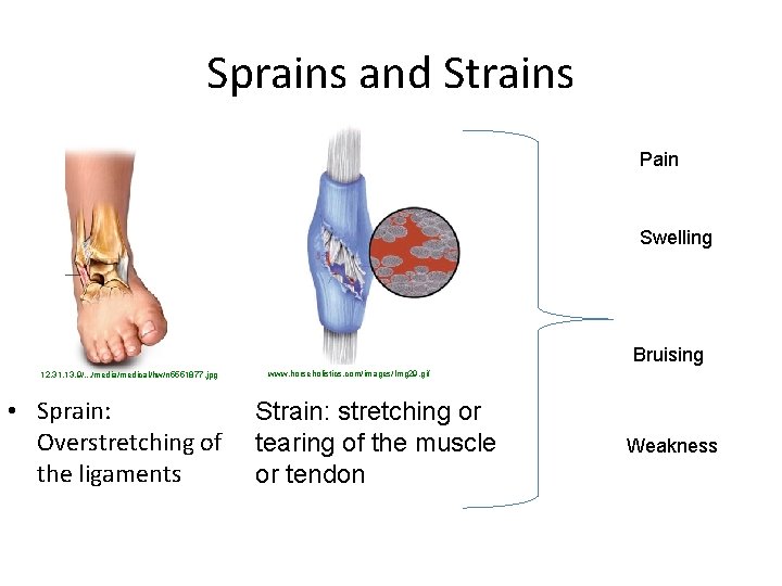 Sprains and Strains Pain Swelling Bruising 12. 31. 13. 9/. . . /media/medical/hw/n 5551877.