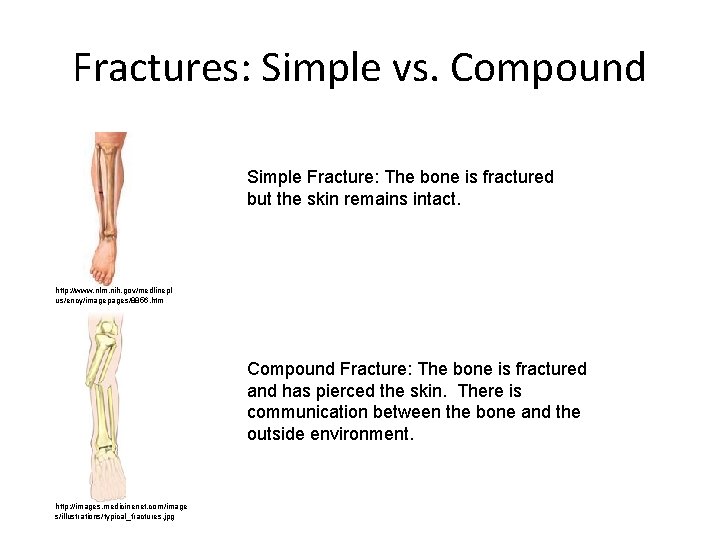 Fractures: Simple vs. Compound Simple Fracture: The bone is fractured but the skin remains
