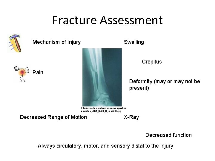 Fracture Assessment Mechanism of Injury Swelling Crepitus Pain Deformity (may or may not be