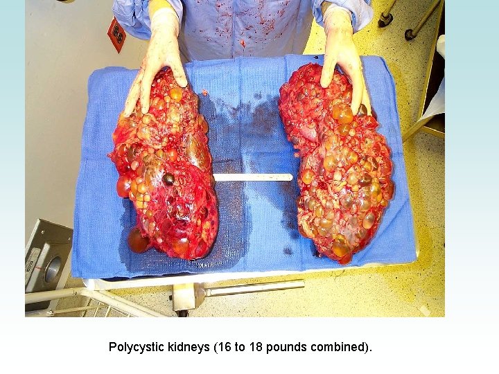 Polycystic kidneys (16 to 18 pounds combined). 