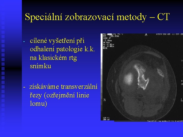 Speciální zobrazovací metody – CT - cílené vyšetření při odhalení patologie k. k. na