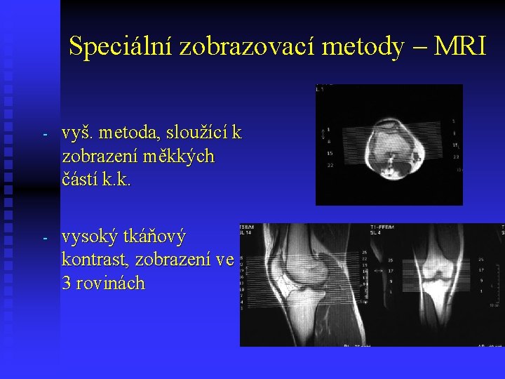 Speciální zobrazovací metody – MRI - vyš. metoda, sloužící k zobrazení měkkých částí k.