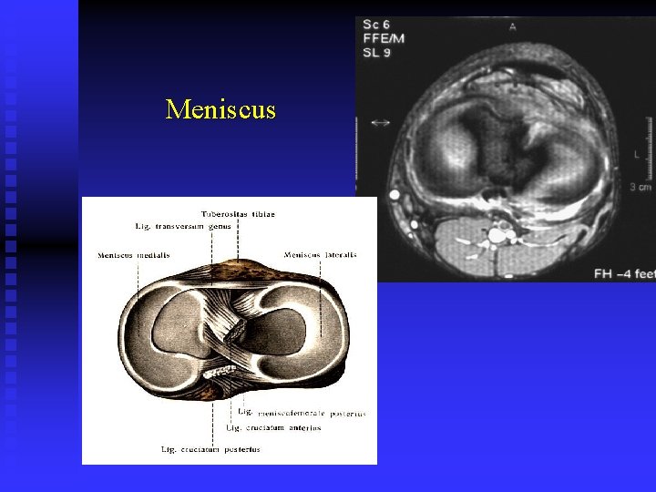 Meniscus 