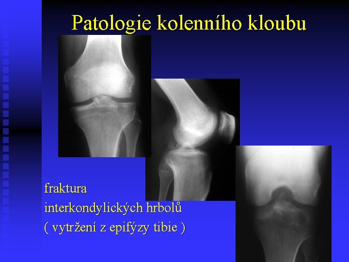 Patologie kolenního kloubu fraktura interkondylických hrbolů ( vytržení z epifýzy tibie ) 