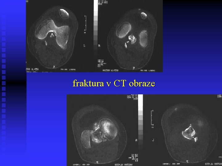 fraktura v CT obraze 