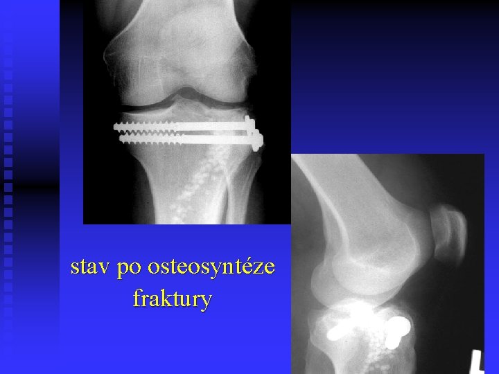 stav po osteosyntéze fraktury 