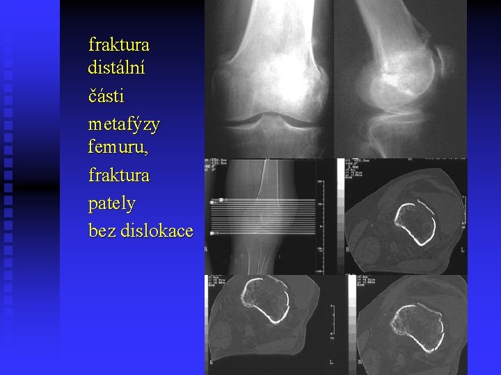 fraktura distální části metafýzy femuru, fraktura pately bez dislokace 