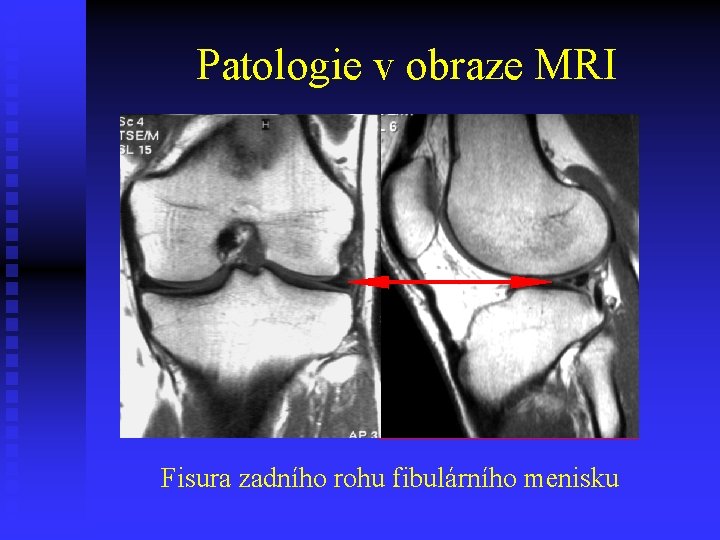 Patologie v obraze MRI Fisura zadního rohu fibulárního menisku 
