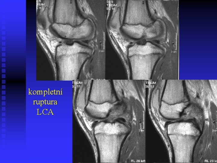 kompletní ruptura LCA 
