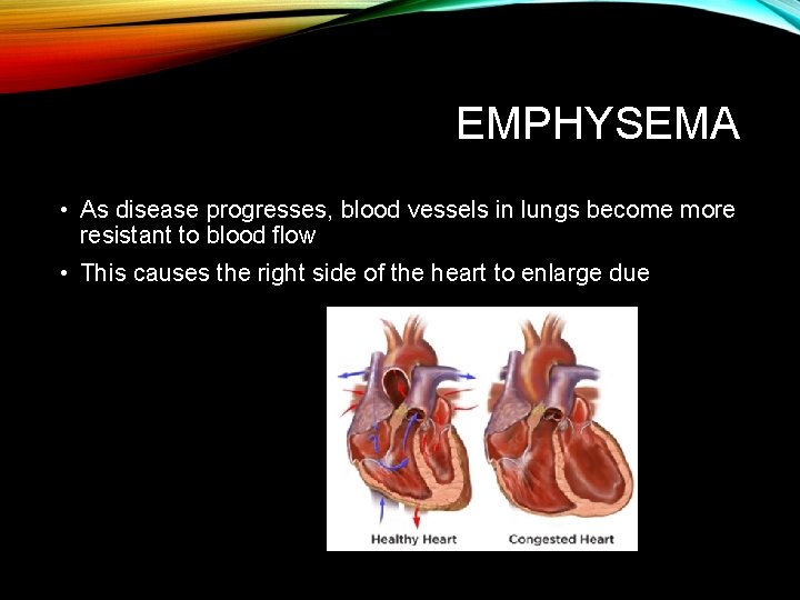 EMPHYSEMA • As disease progresses, blood vessels in lungs become more resistant to blood