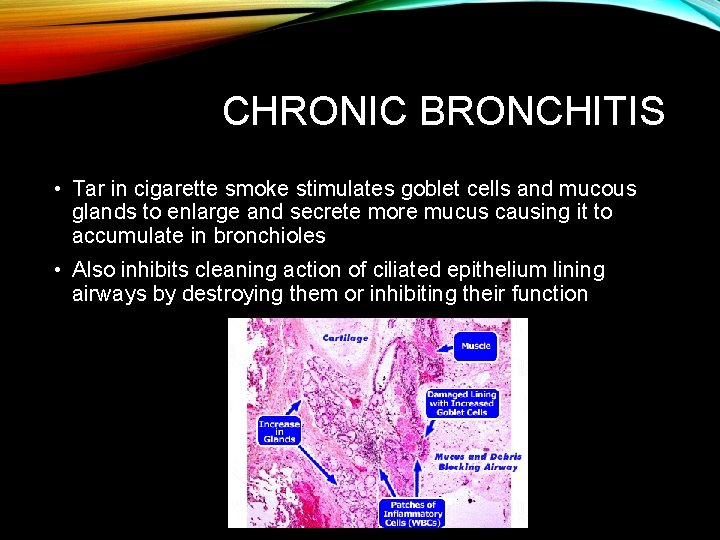 CHRONIC BRONCHITIS • Tar in cigarette smoke stimulates goblet cells and mucous glands to