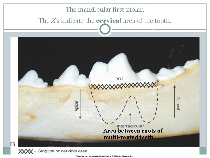 The mandibular first molar. The X’s indicate the cervical area of the tooth. Area