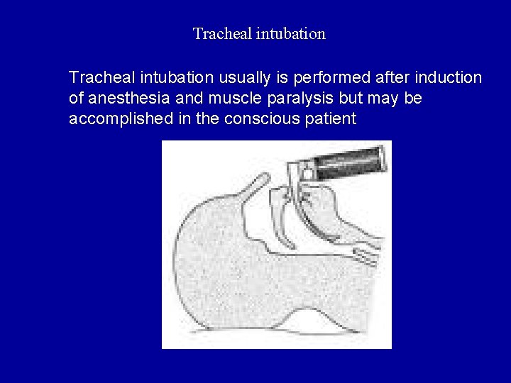 Tracheal intubation usually is performed after induction of anesthesia and muscle paralysis but may