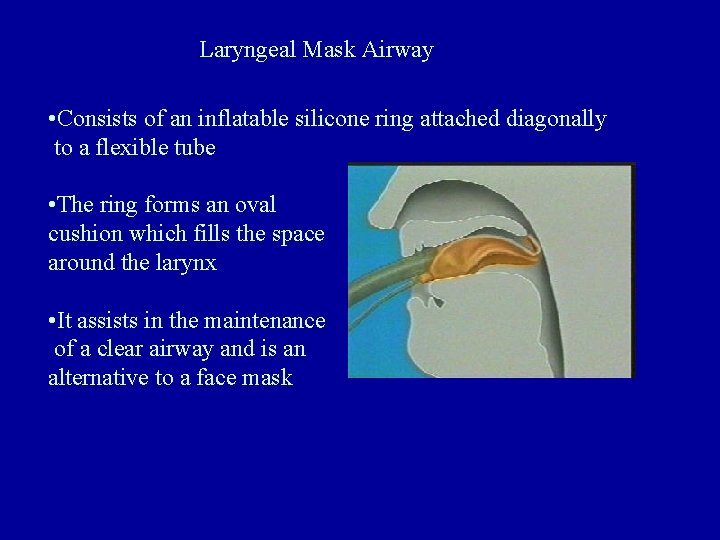 Laryngeal Mask Airway • Consists of an inflatable silicone ring attached diagonally to a