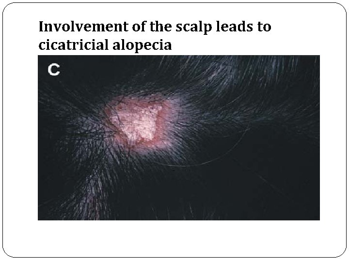 Involvement of the scalp leads to cicatricial alopecia 