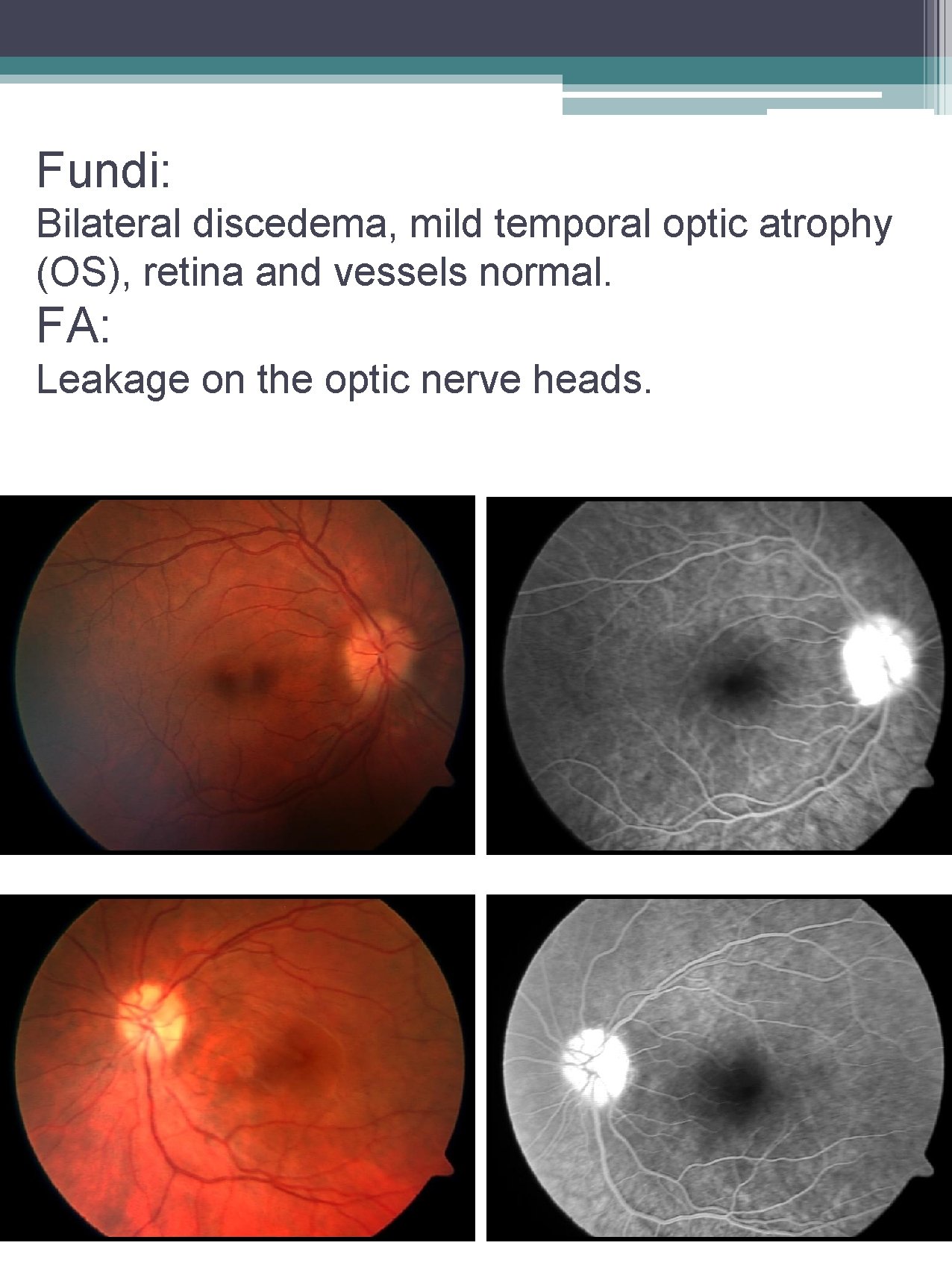 Fundi: Bilateral discedema, mild temporal optic atrophy (OS), retina and vessels normal. FA: Leakage