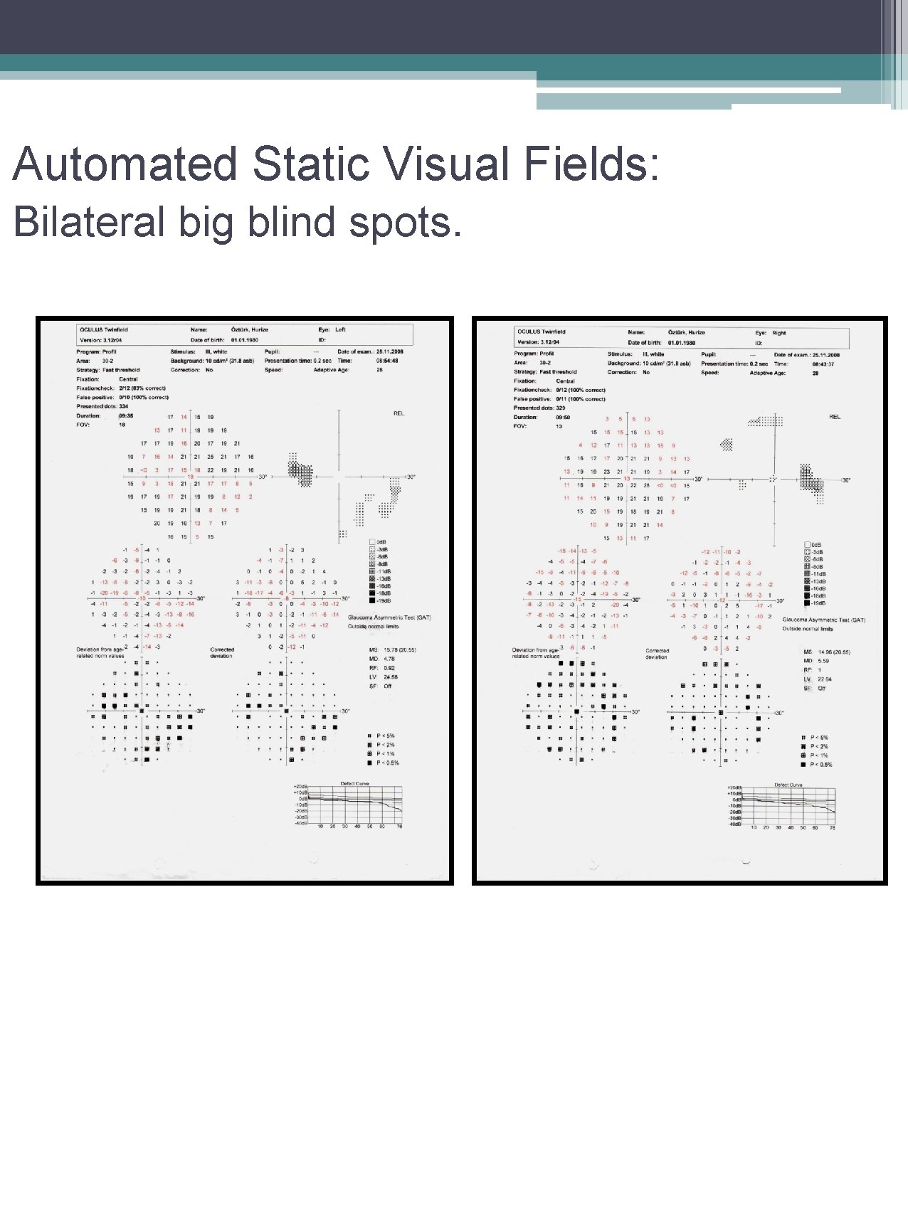 Automated Static Visual Fields: Bilateral big blind spots. 