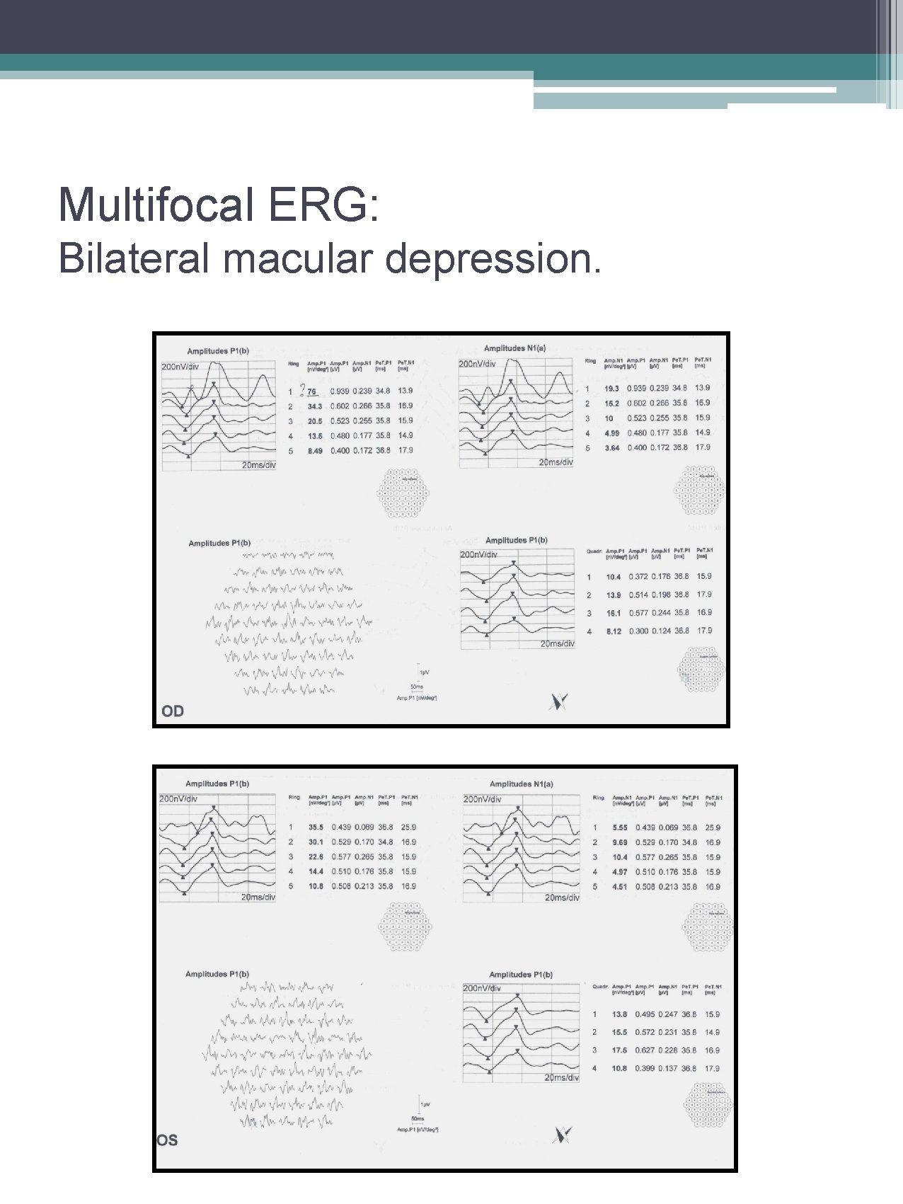 Multifocal ERG: Bilateral macular depression. 