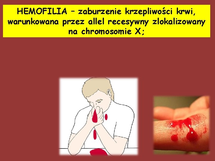 HEMOFILIA – zaburzenie krzepliwości krwi, warunkowana przez allel recesywny zlokalizowany na chromosomie X; 