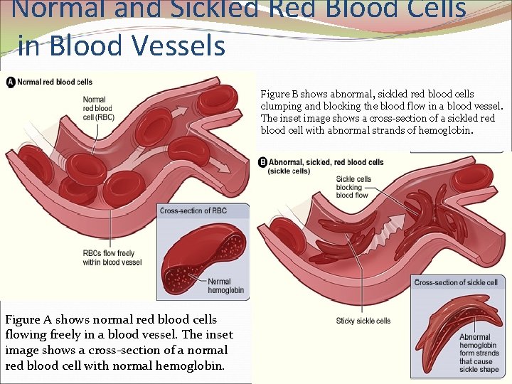 Normal and Sickled Red Blood Cells in Blood Vessels Figure B shows abnormal, sickled