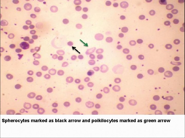 Spherocytes marked as black arrow and poikilocytes marked as green arrow 