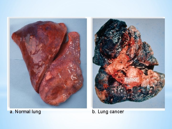 * a. Normal lung b. Lung cancer tumor 
