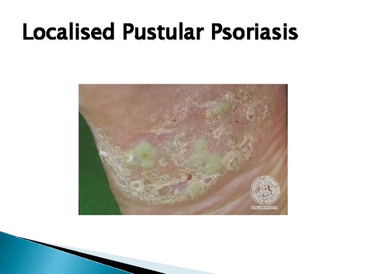Localised Pustular Psoriasis 