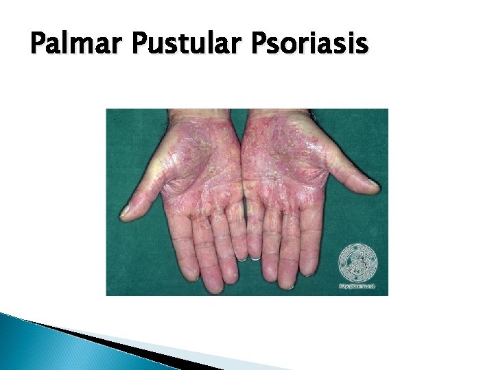 Palmar Pustular Psoriasis 
