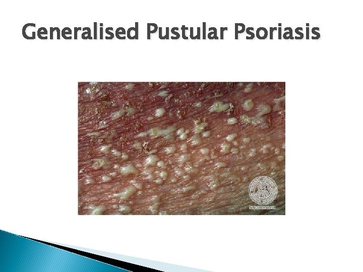 Generalised Pustular Psoriasis 